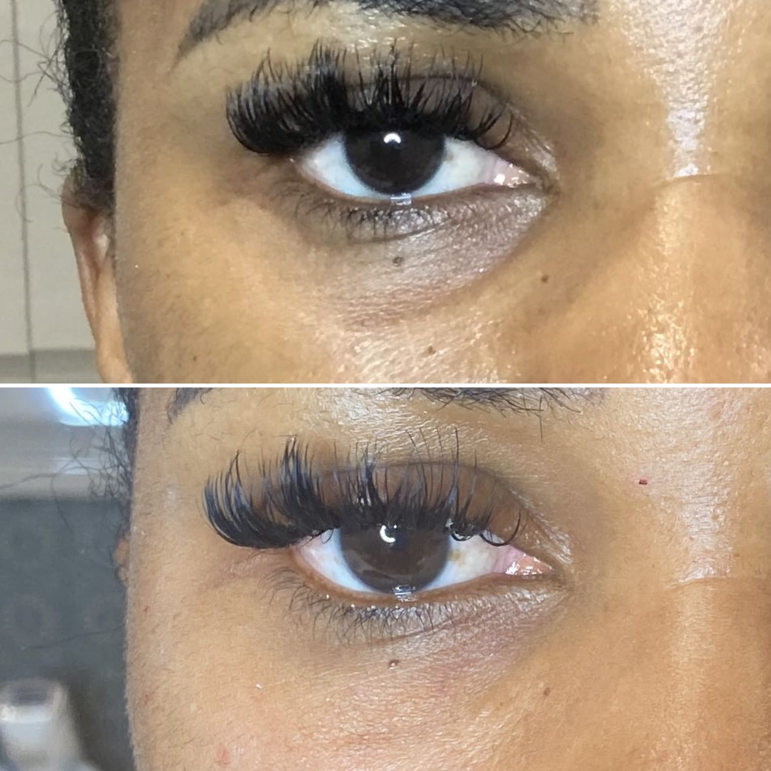 Tear-trough fillers | A close-up of a woman's eye before and after tear trough fillers.