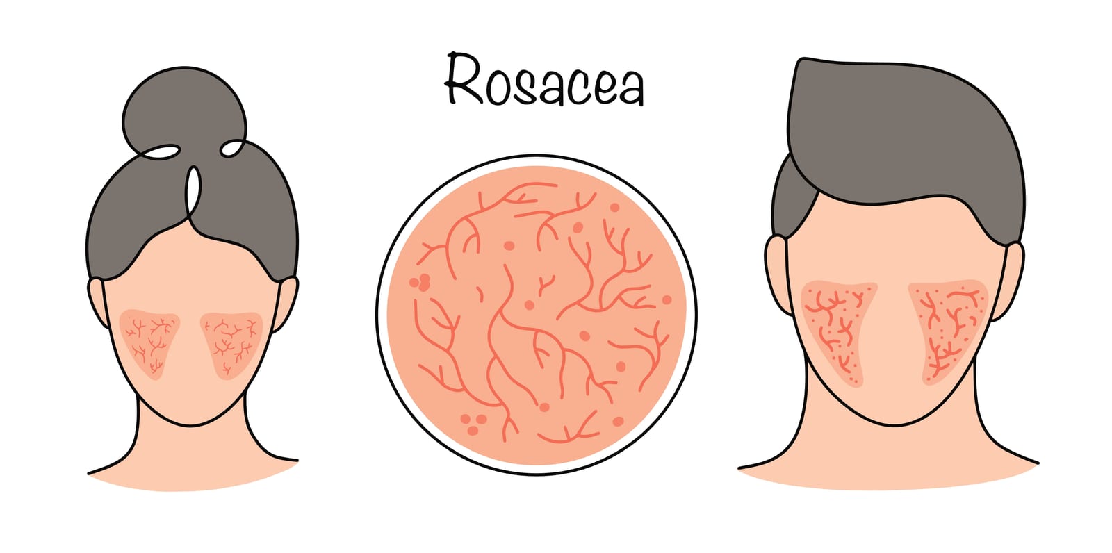 Rosacea | An illustration showing how rosacea appears on the cheeks showing redness and inflammation as the immune system responds to triggers.