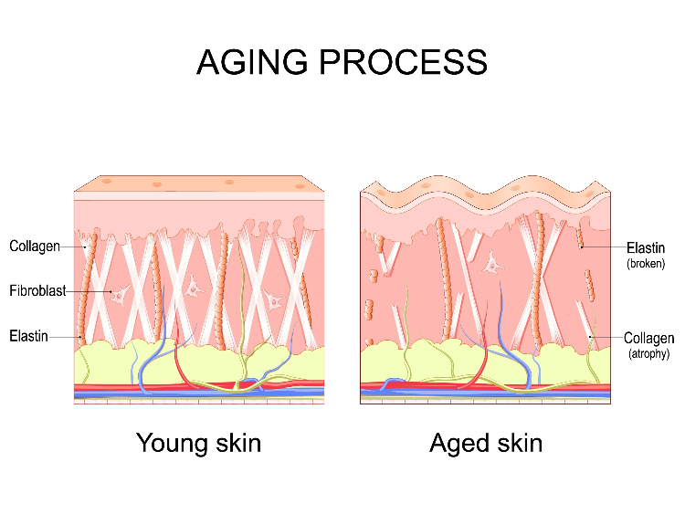 Eye Bags | An illustration of the composition of young skin versus aged skin.