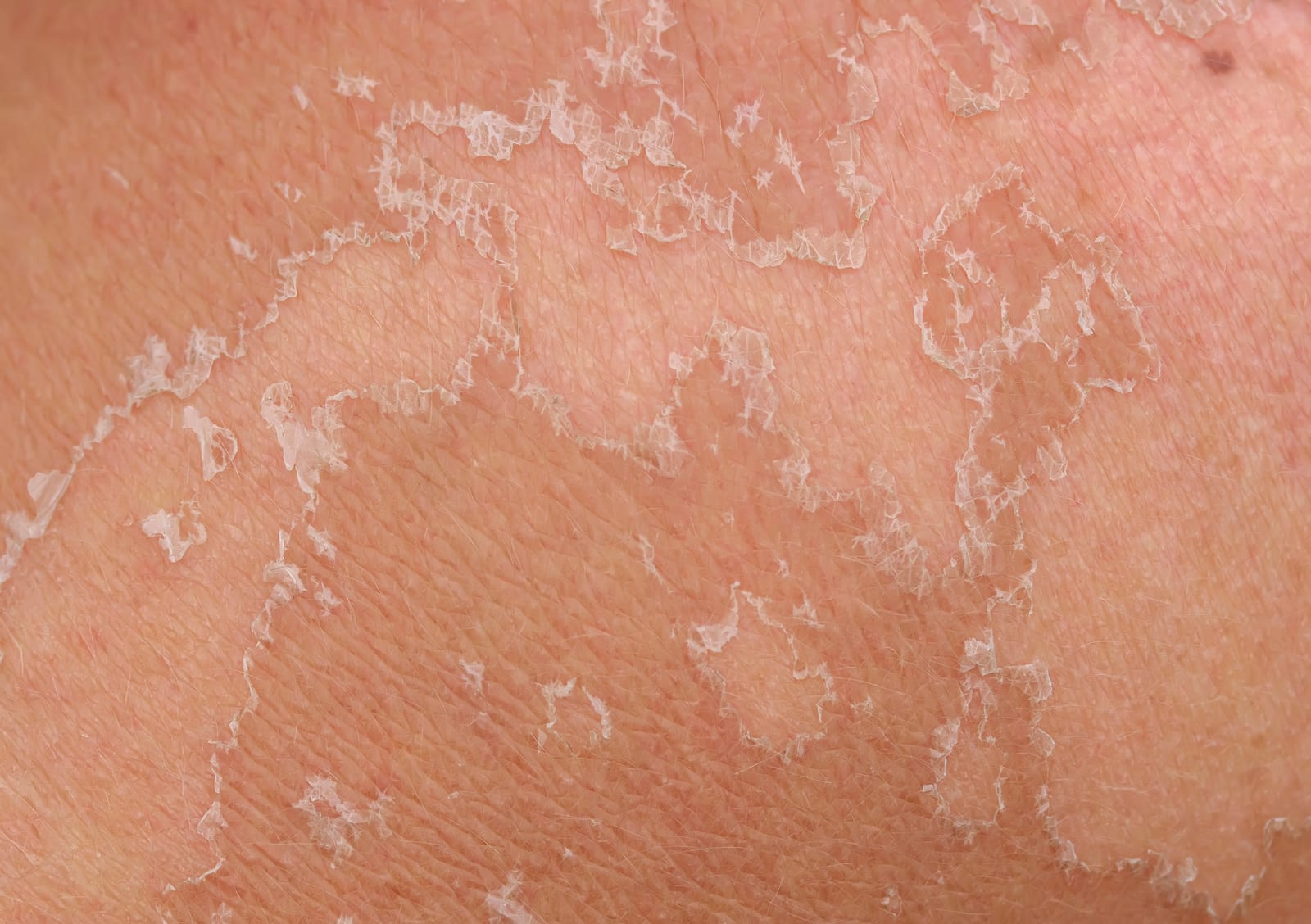 Green Peel | A photo of skin shedding after a green peel.