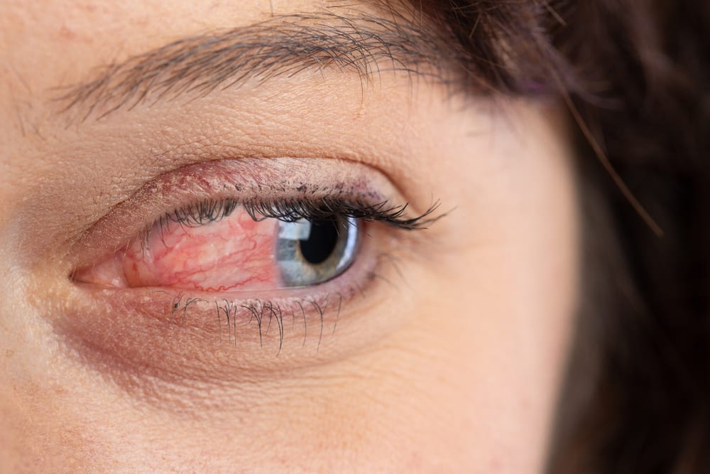 Rosacea | A woman with Ocular Rosacea showing her eyes sore, watery and bloodshot.