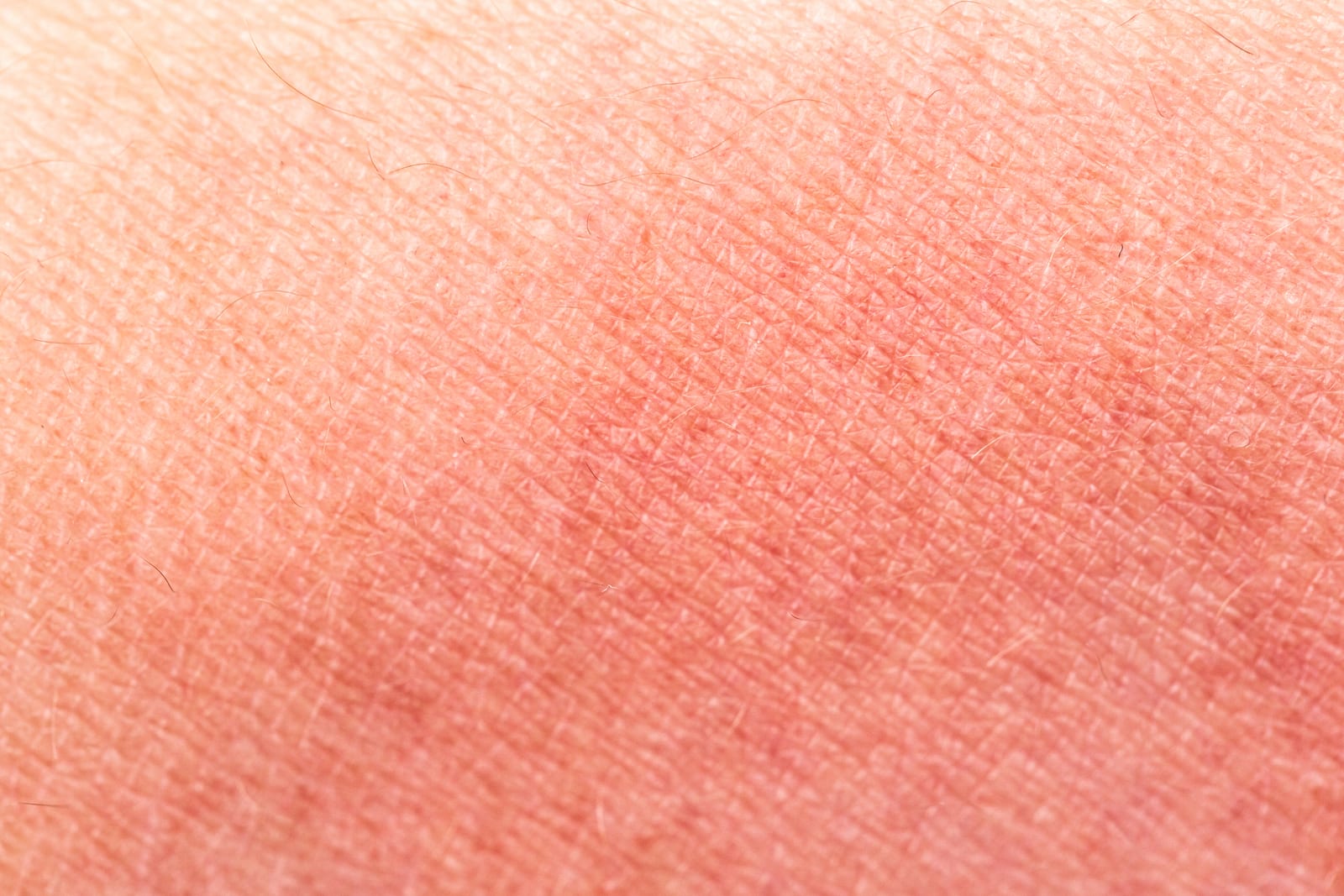Exilis | A photo of red skin from increased blood flow