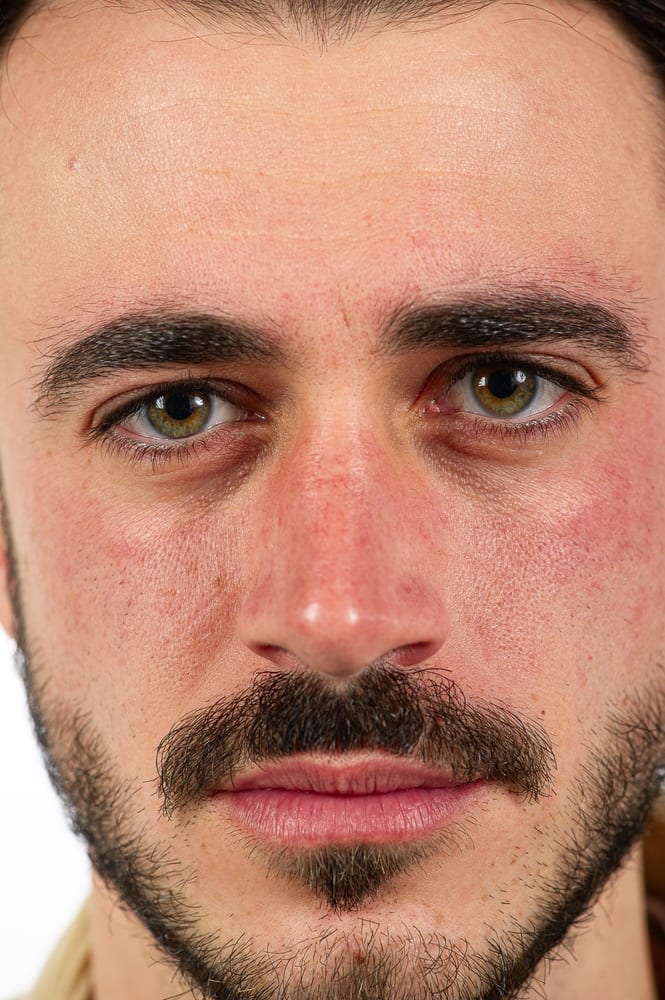 Rosacea | A man suffering from phymatous rosacea and you can notice clearly the bumpy nose.