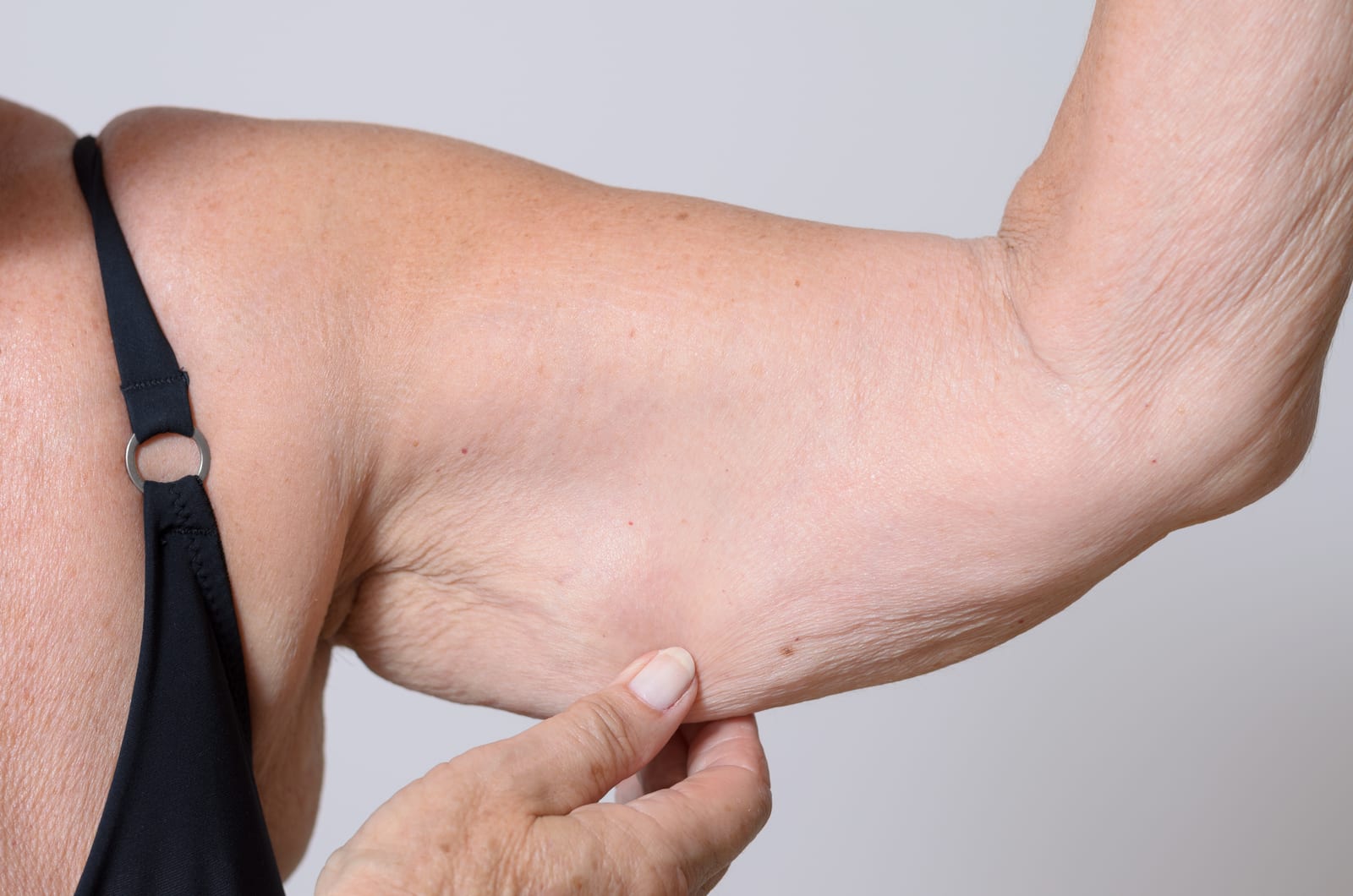 Exilis | An elderly woman pinching sagging skin on her arm