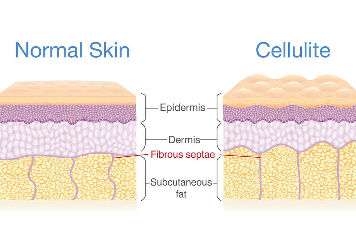 3 Benefits of Exilis Body Contouring Treatment