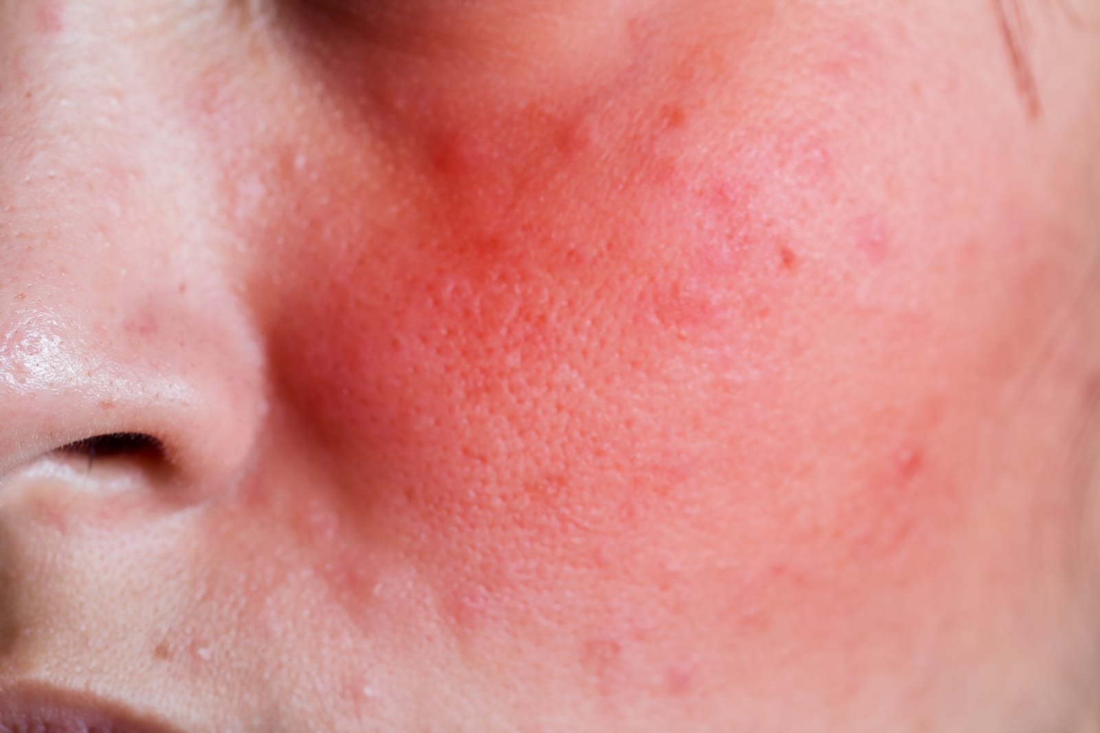 Skin Treatment | An allergic reaction on a woman's cheek