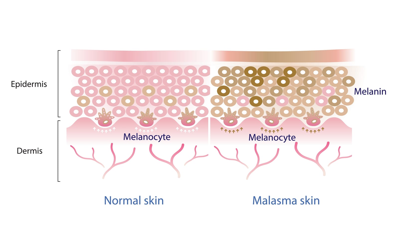 Melasma | An illustration of the cellular difference between normal skin and melasma skin.