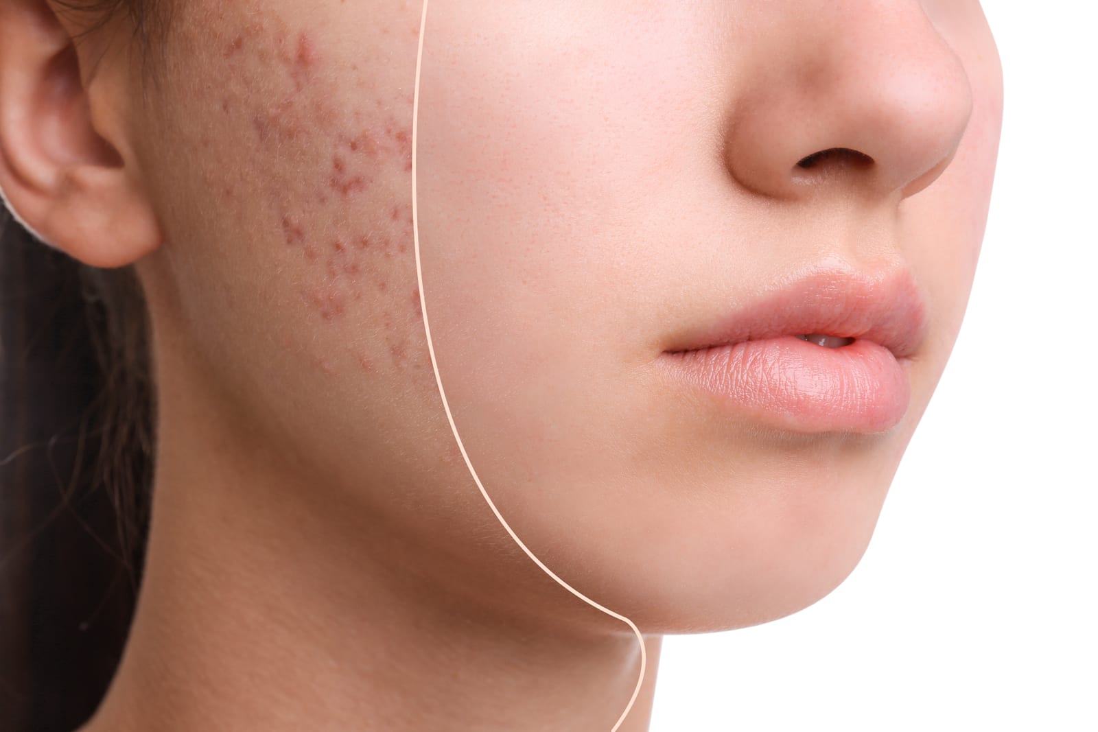 HydraFacial | A picture showing the difference between acne and clear skin.