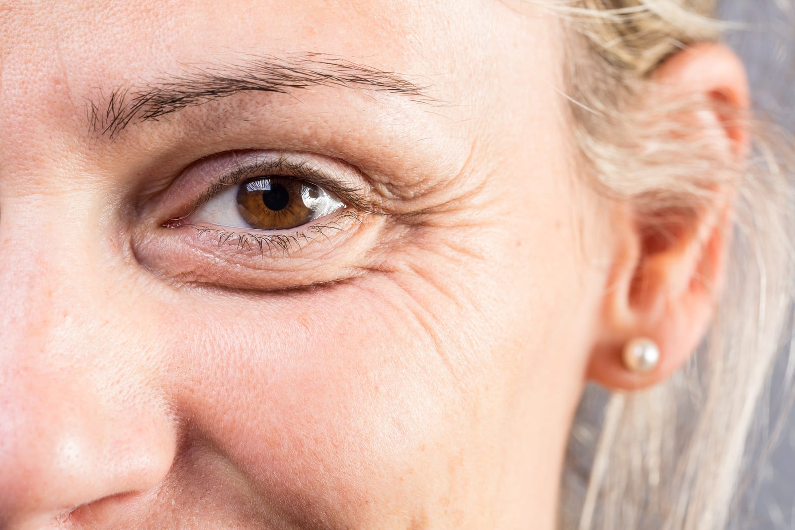 ClearLift | A close-up of a smiling woman's eye
