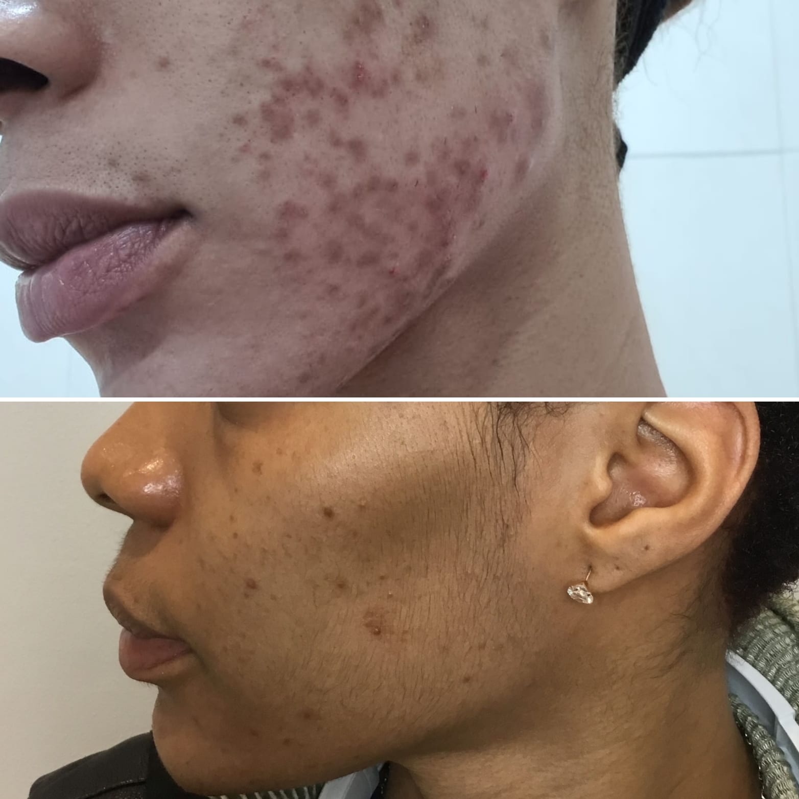 Acne Treatment | A close-up  image of a person's cheek before and after acne treatment.