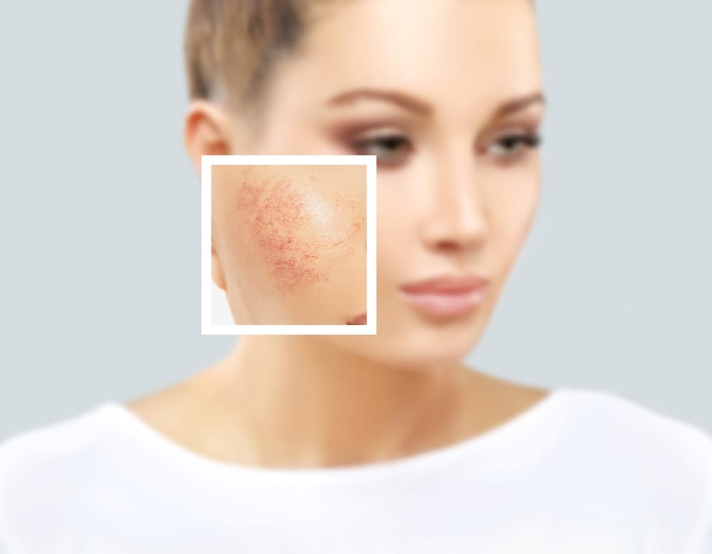 Rosacea | A young woman with vascular rosacea has facial redness and the blood vessels look more visible.