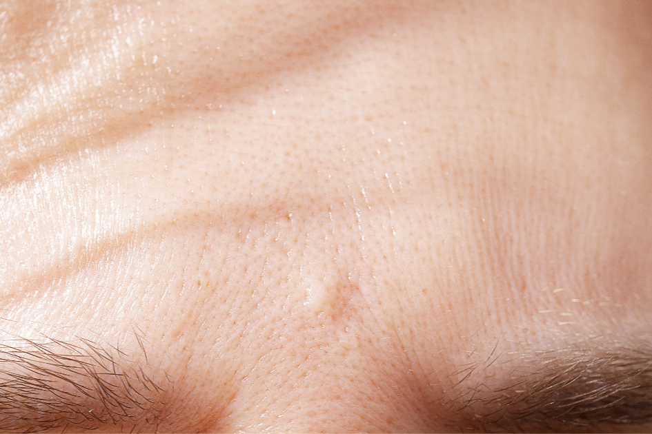 Acne Scarring | A photo of a hypertrophic acne scar on the forehead.