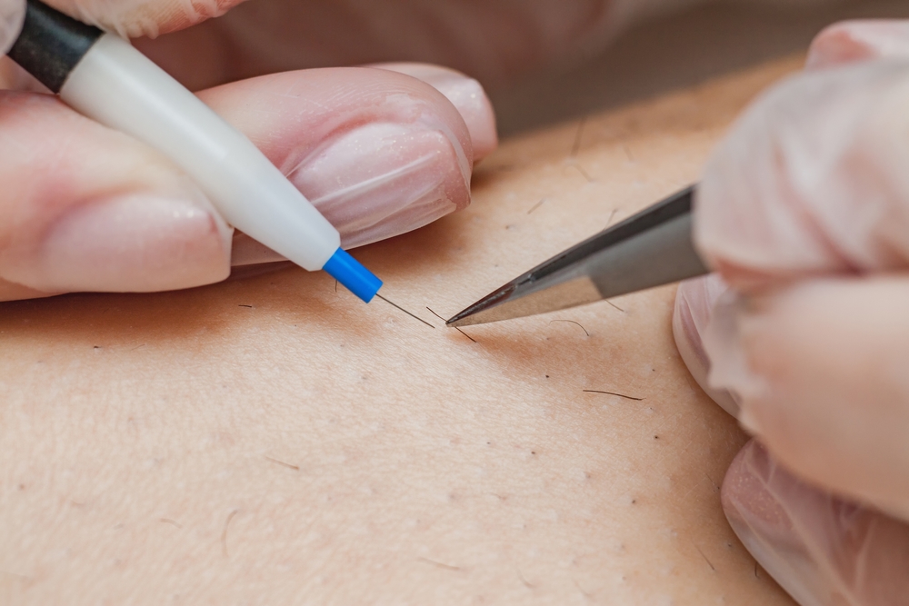 Electrolysis Hair Removal | Dr Hala London
