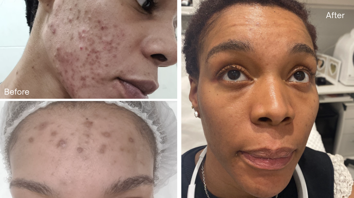 Understanding Acne-Prone Skin