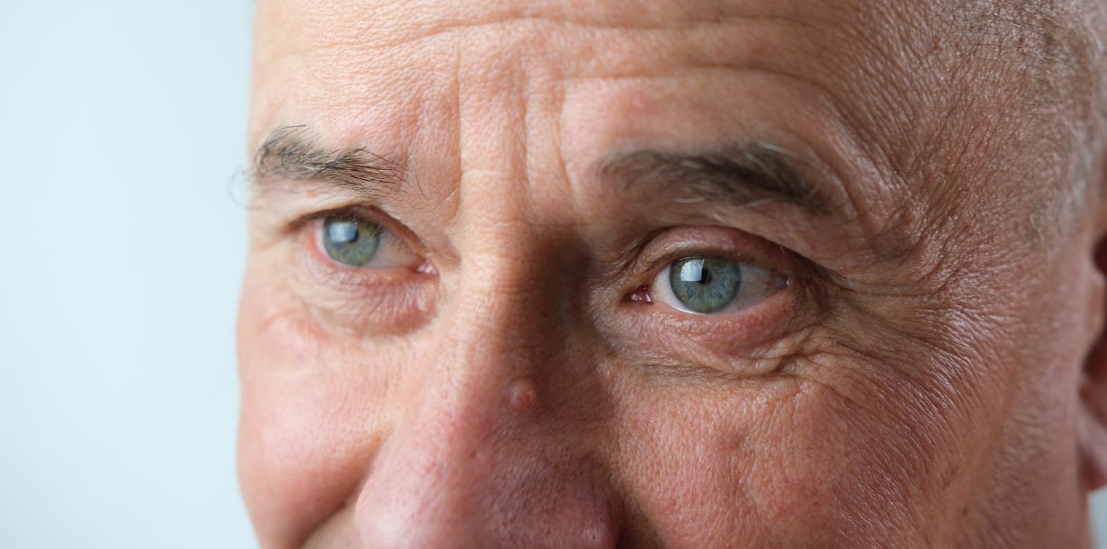 HydraFacial | A man's face with deep wrinkles