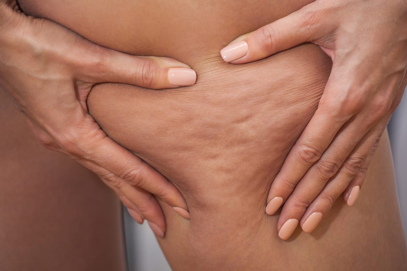 Exilis Treatment | A photo example of cellulite on the thigh