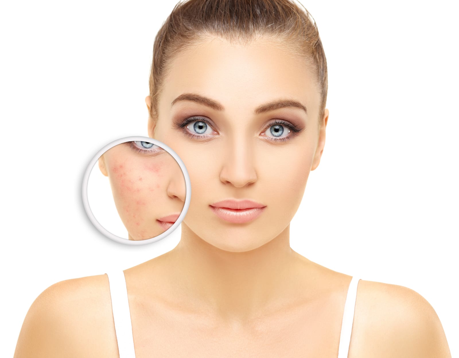Green Peel | A photo of a woman with a section zoomed-in on acne