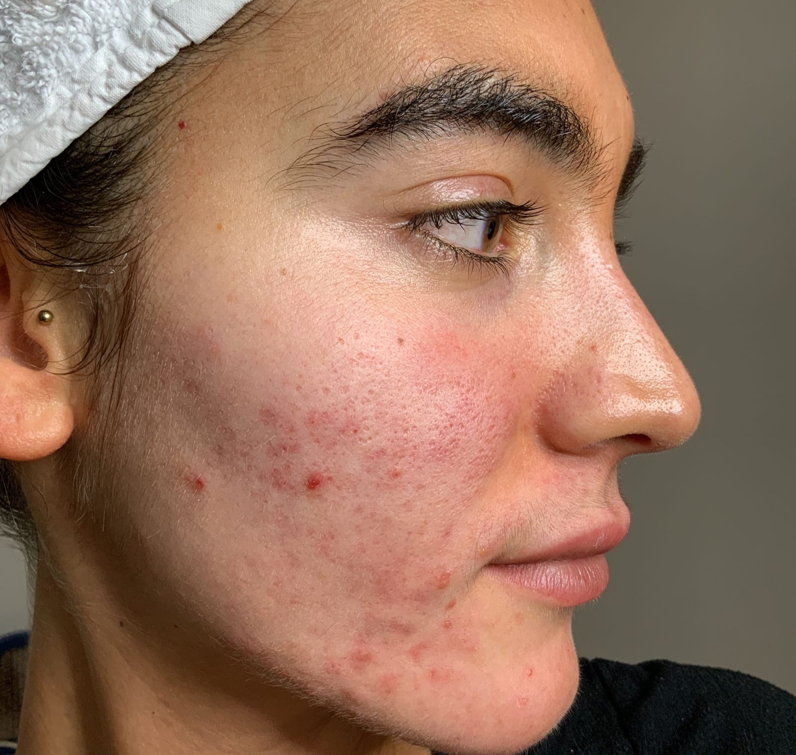 Acne Treatment | A side profile picture of a woman with active acne on her cheeks