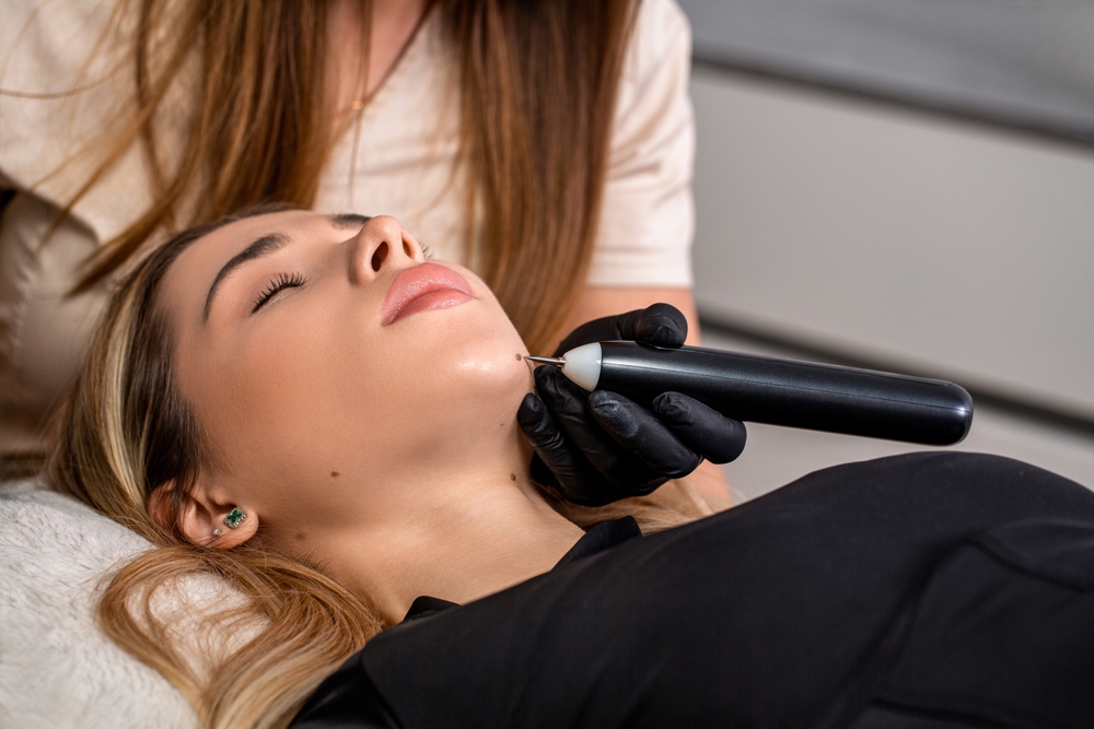 PlexR Mole, Skin Tag & Wart Removal | Dr Hala Medical Aesthetics London