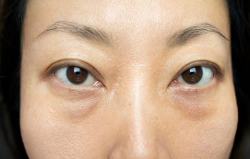 Eye Bags | A photo of a woman with prominent under eye bags.