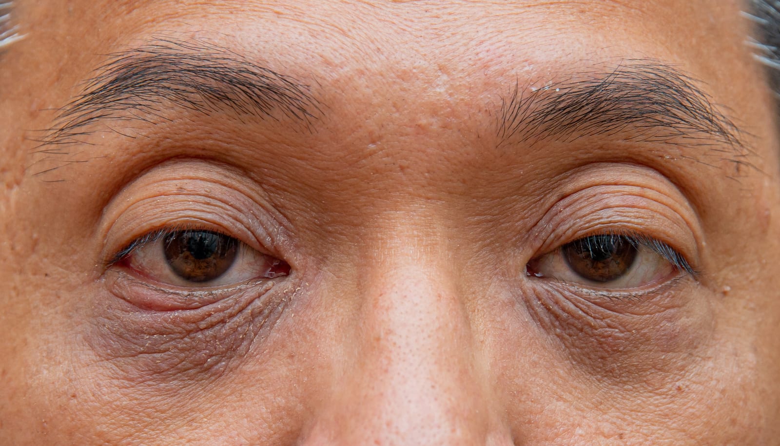 Dark circles | A close-up of man's eyes with dark eye bags.