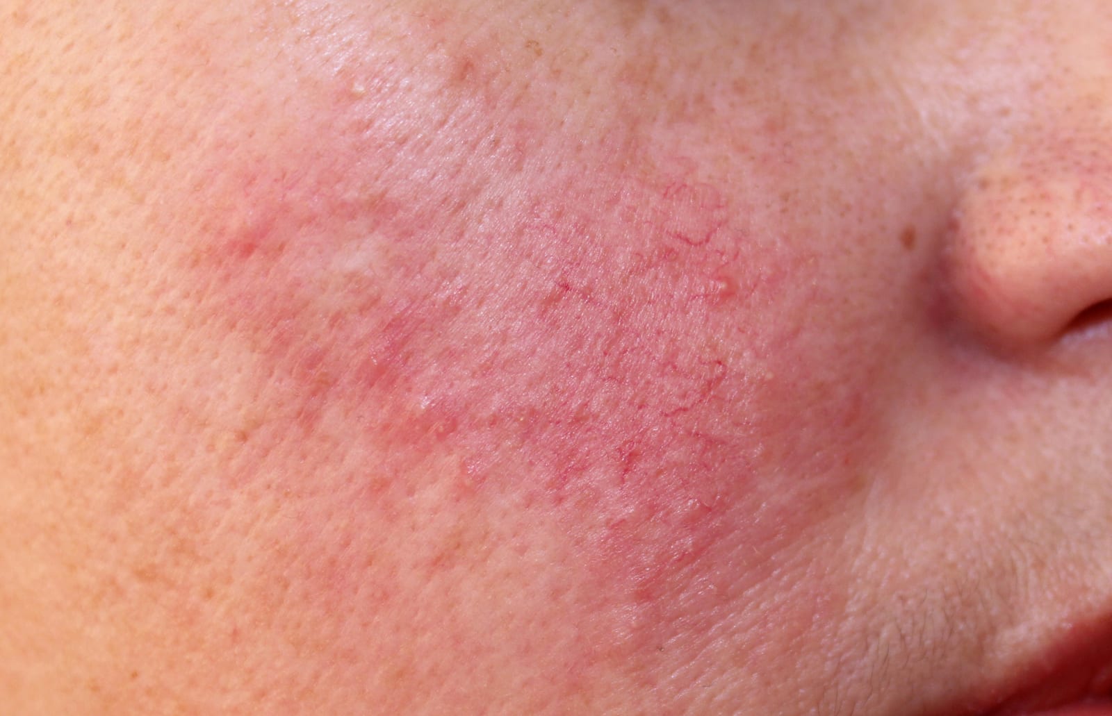 An example of rosacea skin