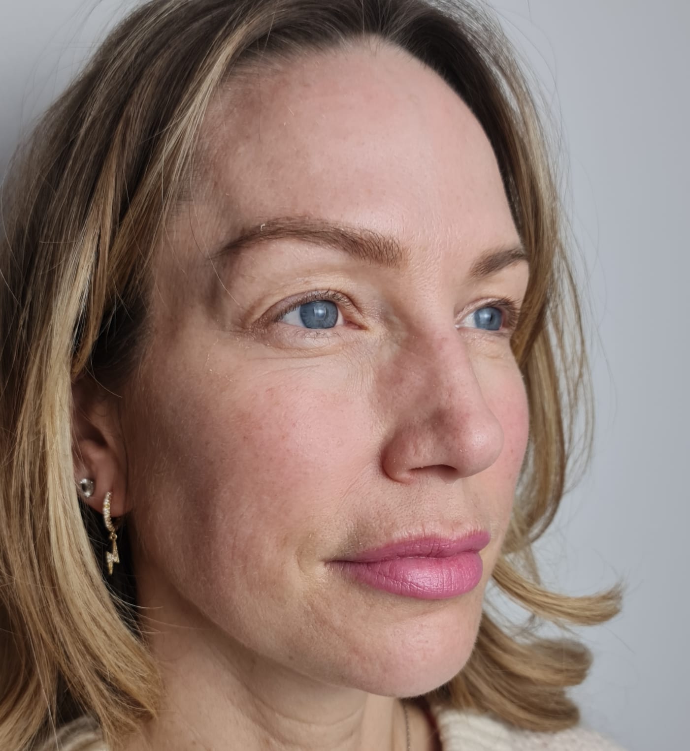Laser Resurfacing | A photo of a client before laser resurfacing.