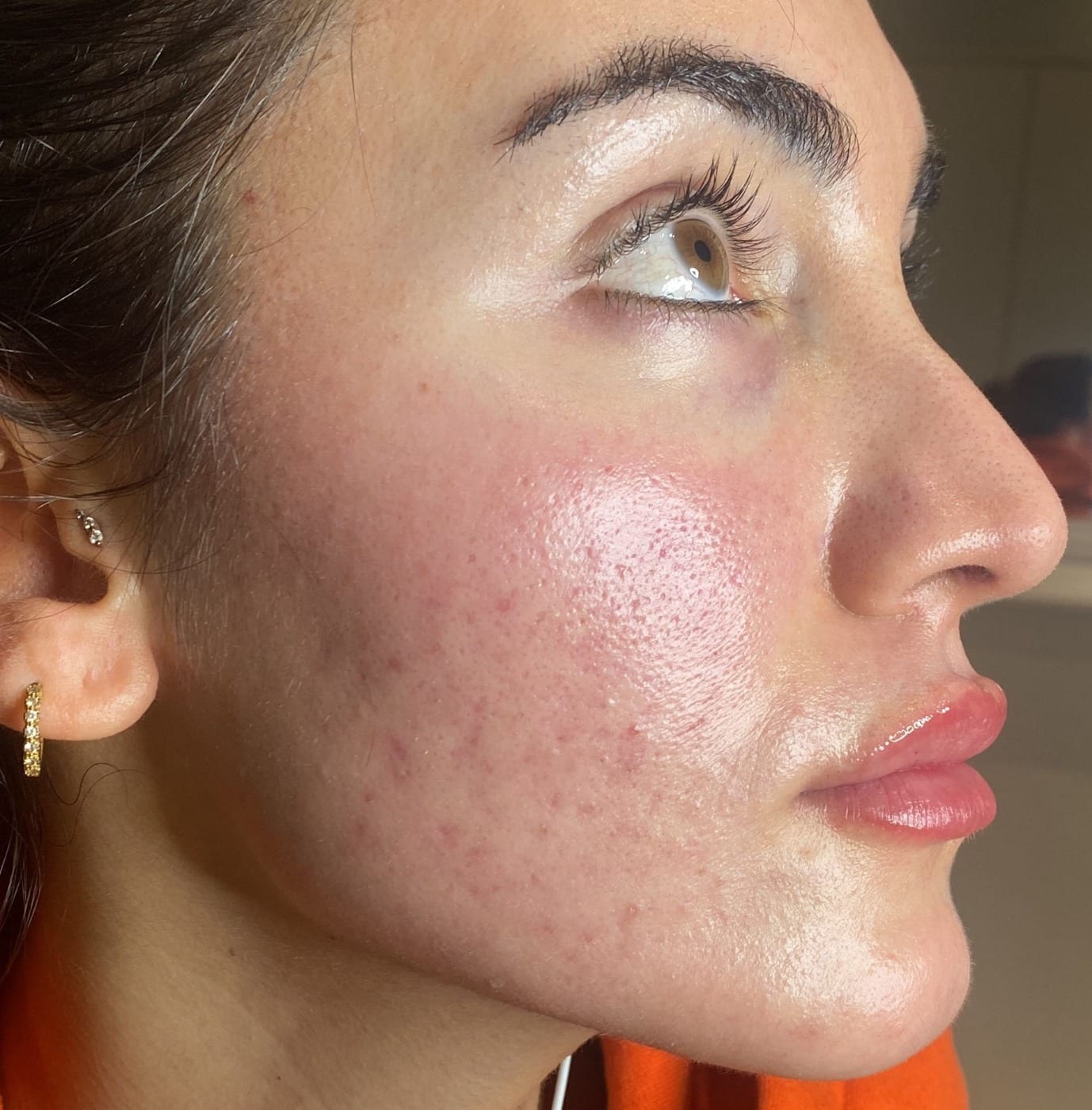 Acne Treatment | A side profile picture of a woman after receiving acne treatment.