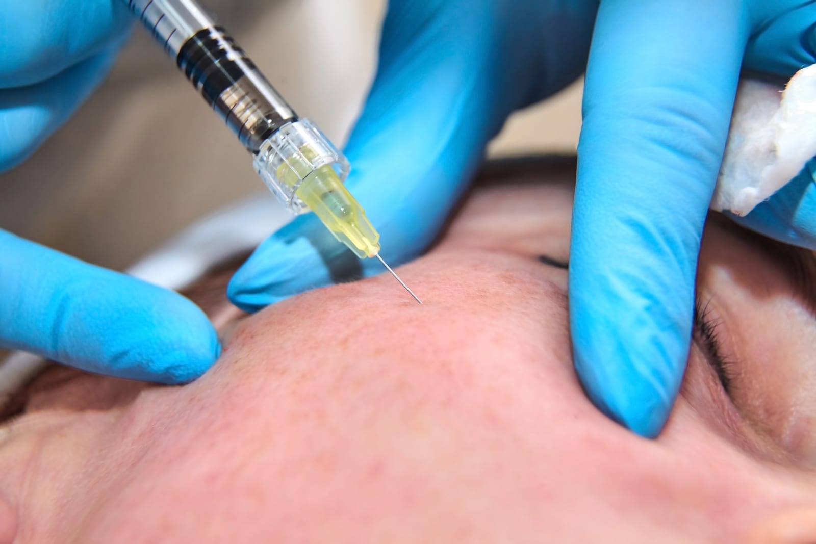 Polynucleotide | A close-up of an injection into a person's cheek.