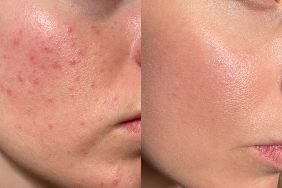 The Truth About Curing Acne: What You Need to Know