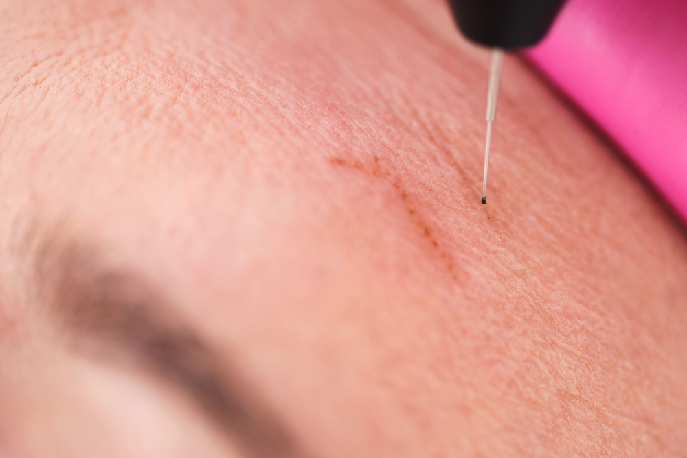 PlexR Plasma Skin Tightening | Dr Hala London
