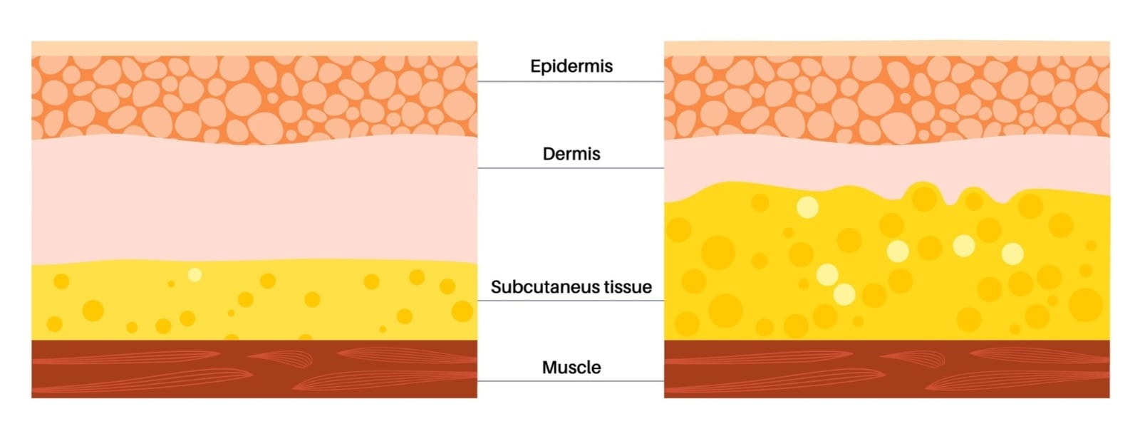 Exilis | An illustration of healthy tissue and tissue with excess fat