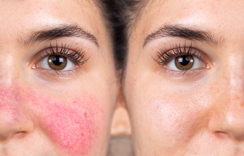 Rosacea | A photo for a young woman looking happy after following the right skincare routine, successfully managing the symptoms and regaining confidence in her skin.