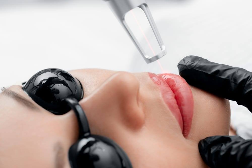 Melasma | A person having a laser treatment that is good for Melasma.