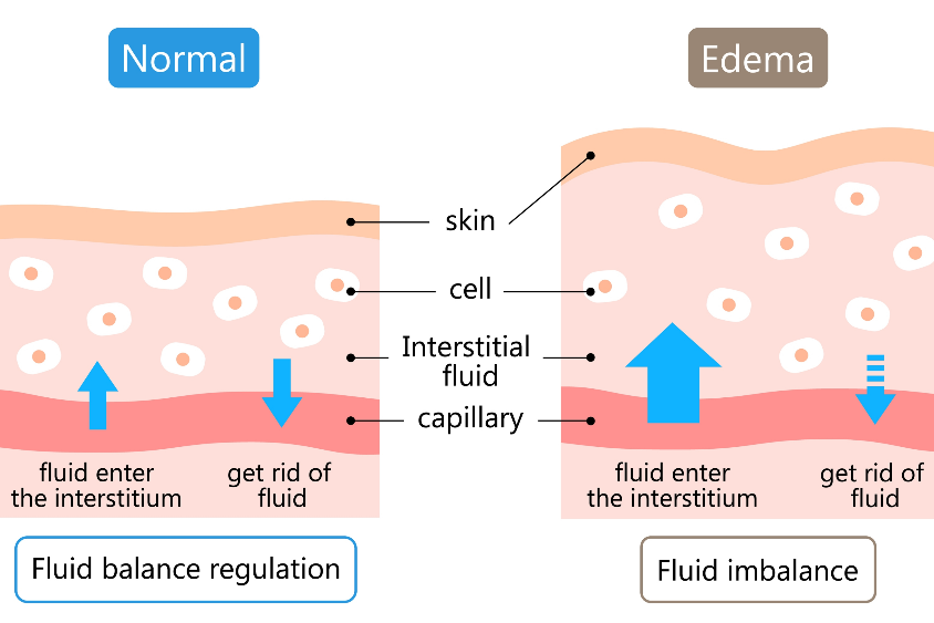 Eye Bags | An illustration of fluid retention in normal skin versus edema.