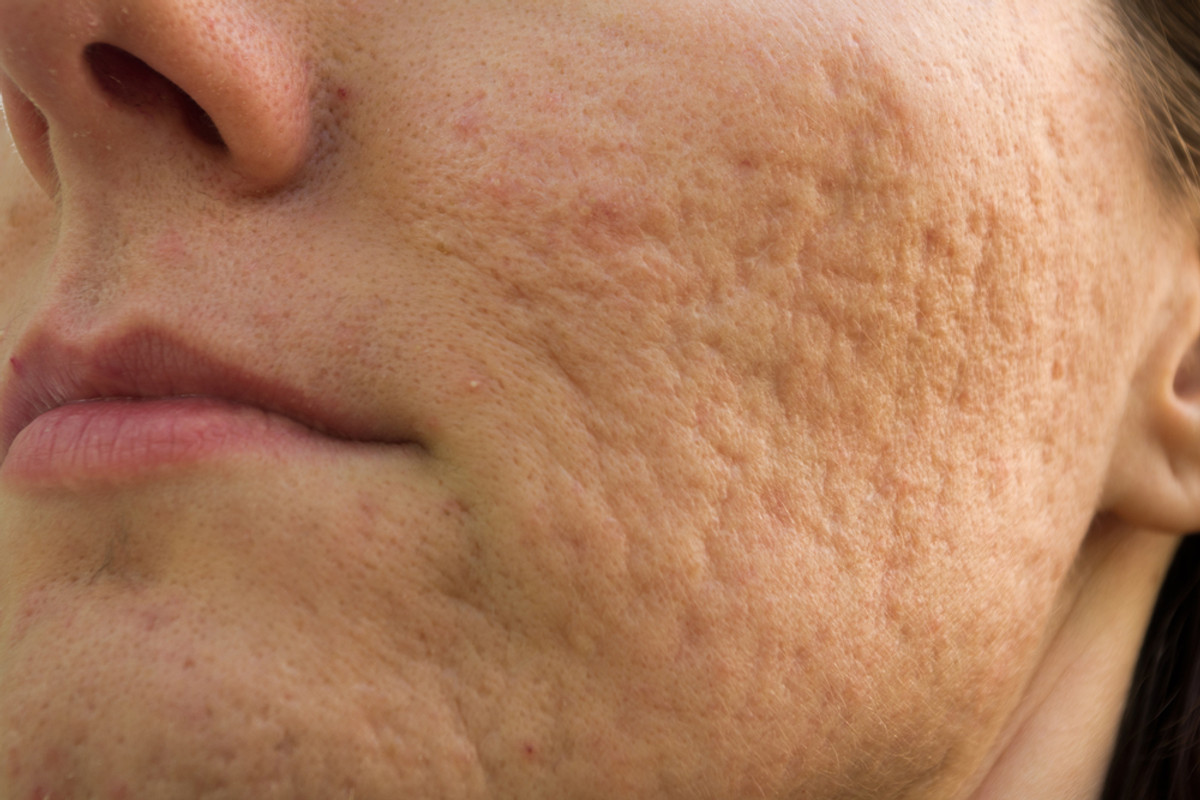 Acne Scarring: What, Why, How?