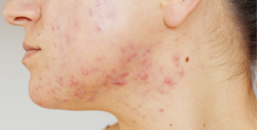 Acne Scarring | A side profile photo of a woman with severe acne on the jaw area.