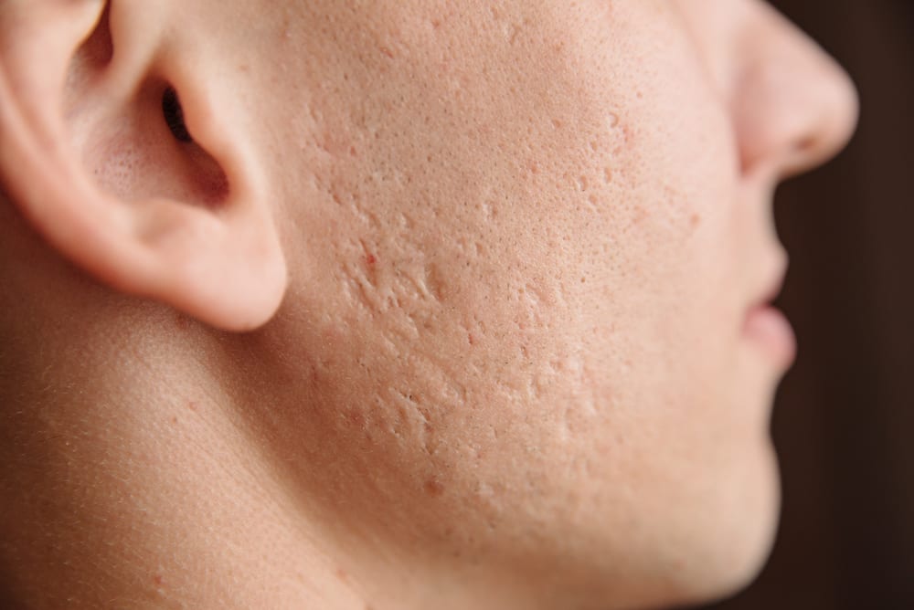 Acne Scarring | A photo of boxcar acne scars on a man's cheek