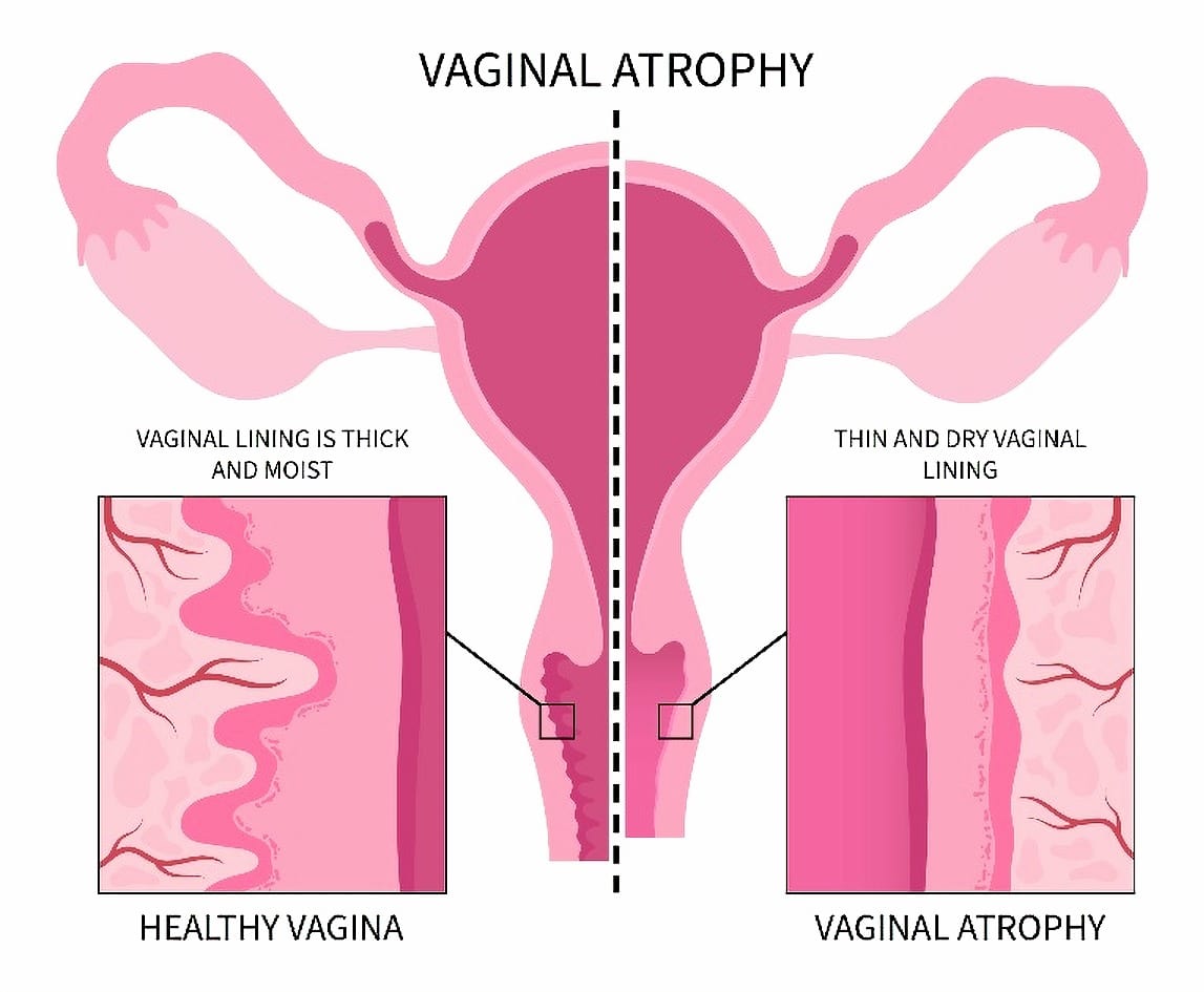 FemiLift | An illustration of healthy vaginal tissue against vaginal atrophy