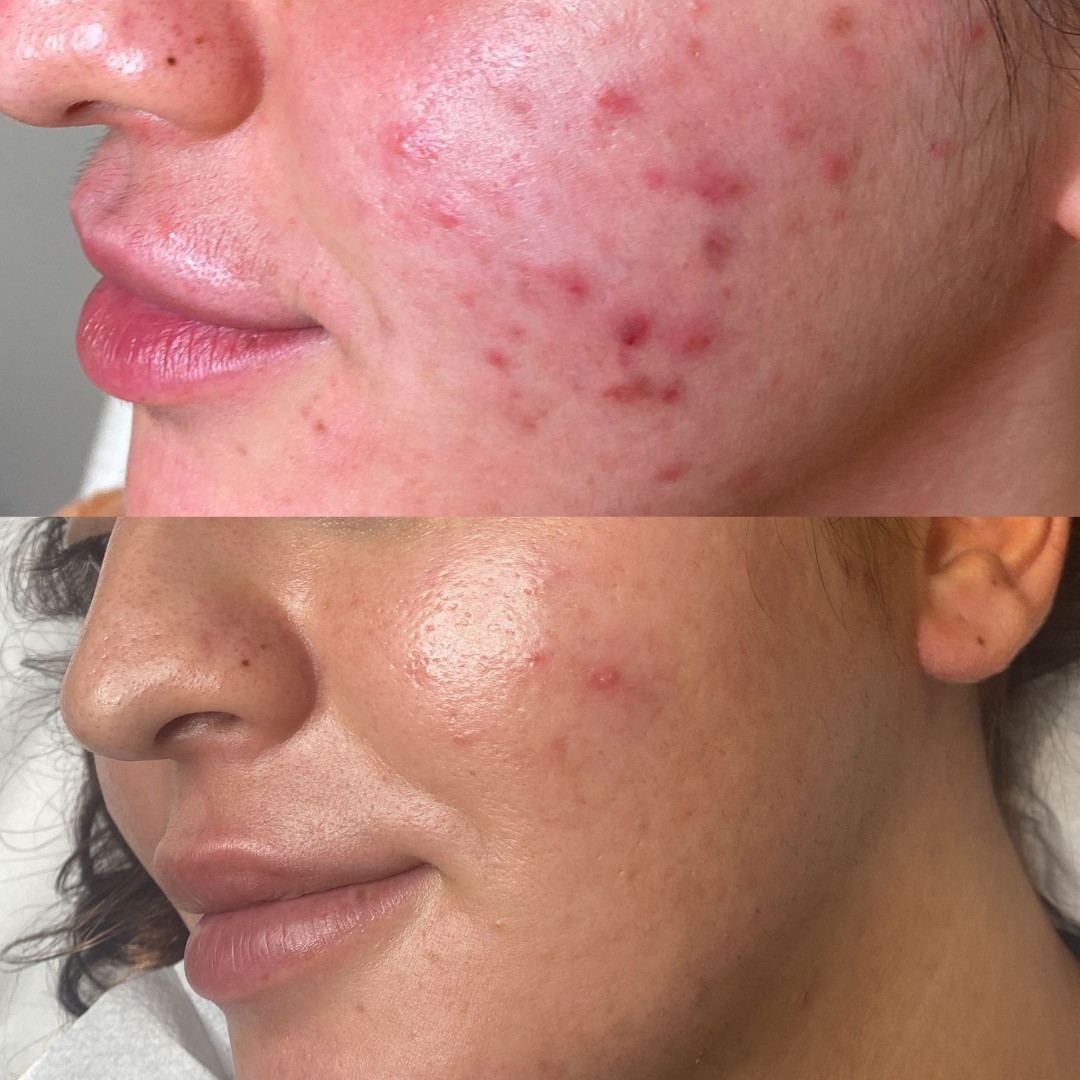Acne Cure | A close up before and after of acne treatment from a client at Dr Hala Medical Aesthetics