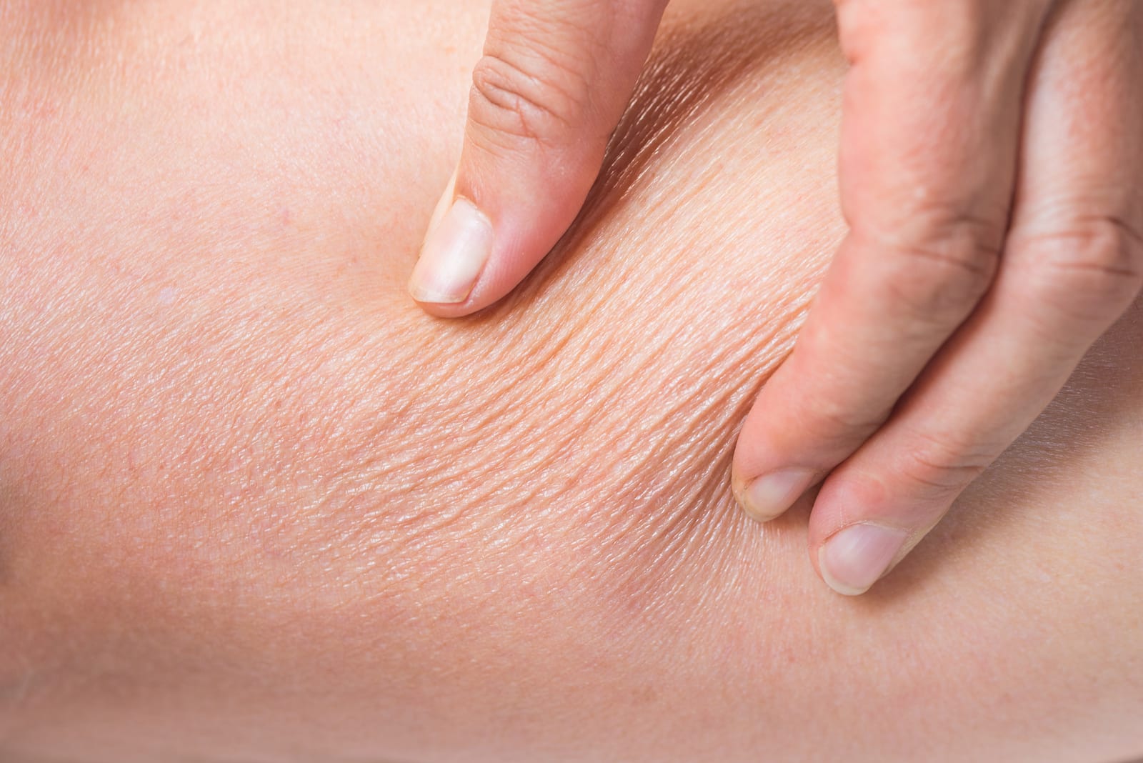 Exilis | A photo of someone pinching excess loose skin.