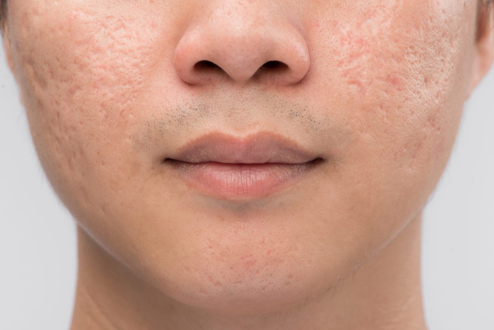 HydraFacial | A man with acne scarring on the cheeks