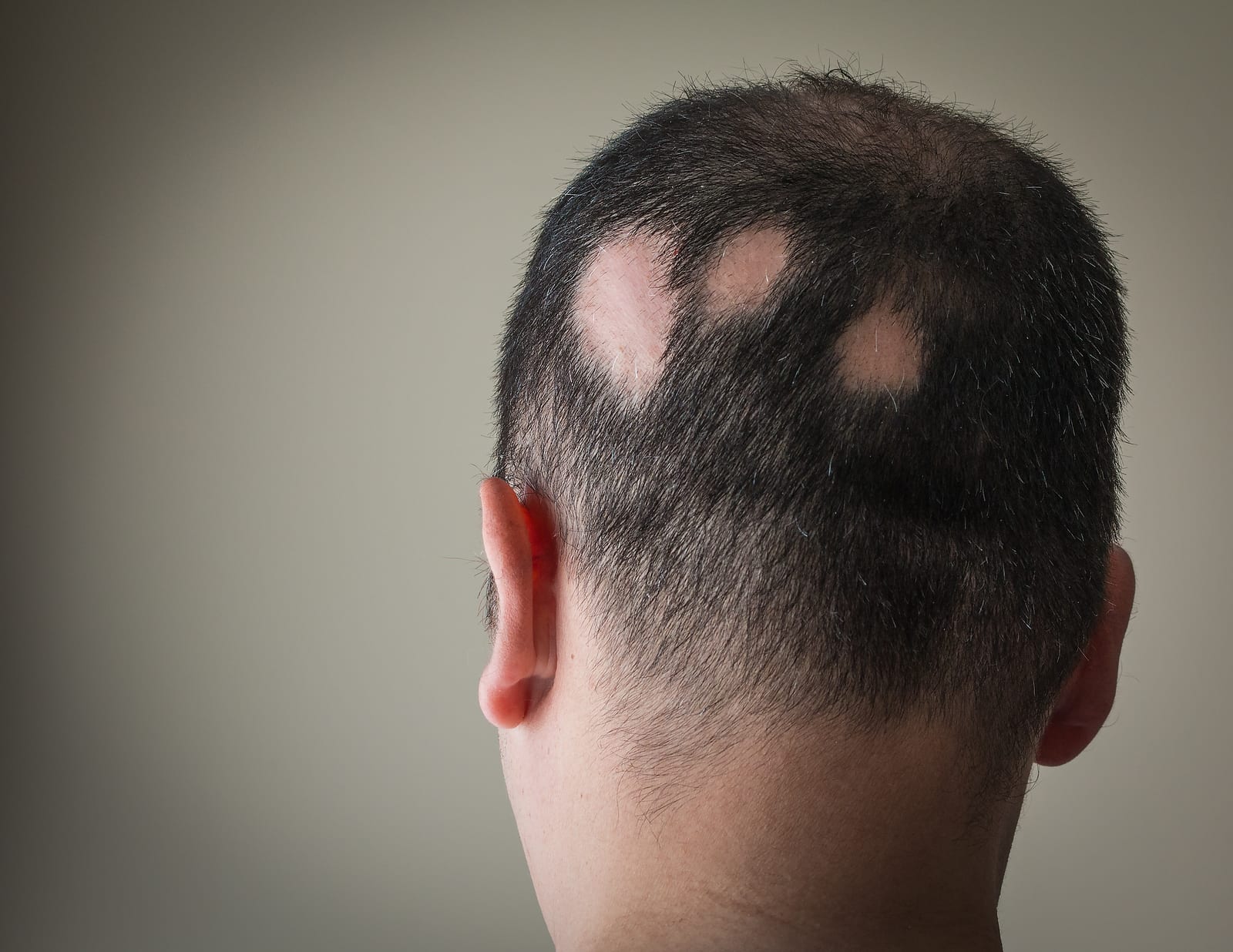 Hair Loss