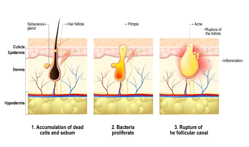 Acne Scarring | An illustration of the acne development process.