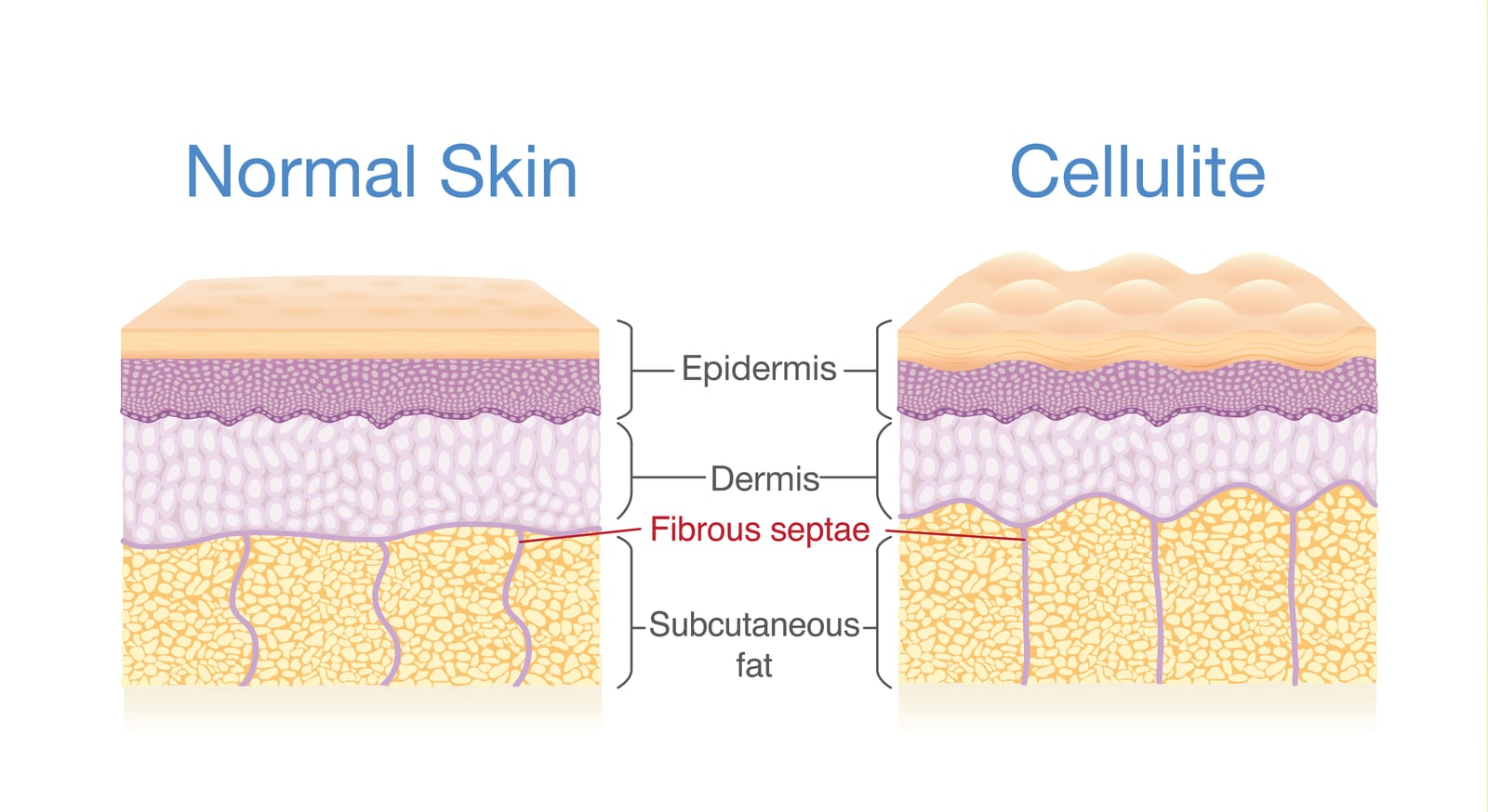 Cellulite | A scientific illustration of normal skin versus skin with cellulite