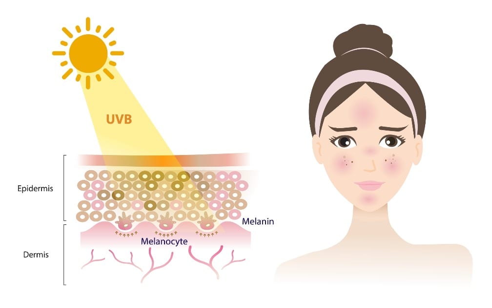 Melasma | An illustration of the sun's UVB rays causing pigmentation and Melasma at the cellular level.