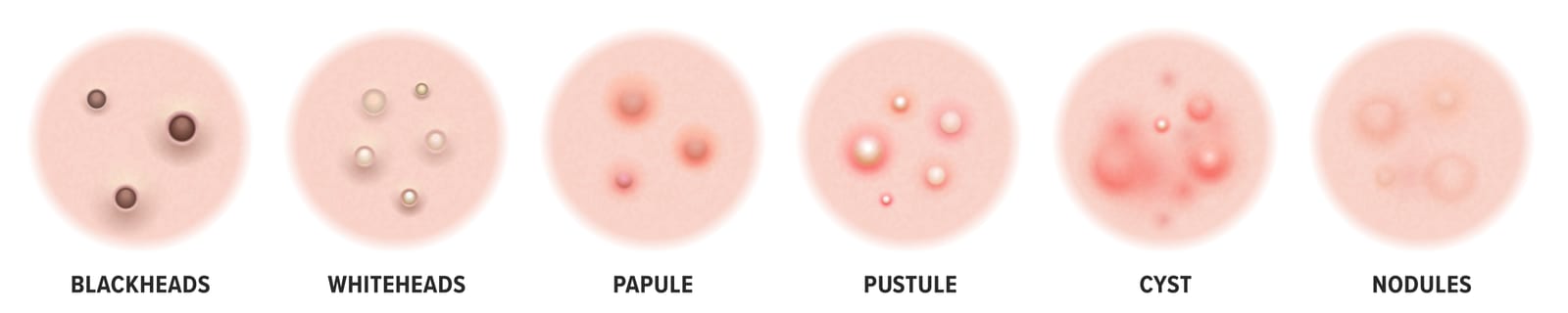 Acne treatment | A picture showing different type of acne.