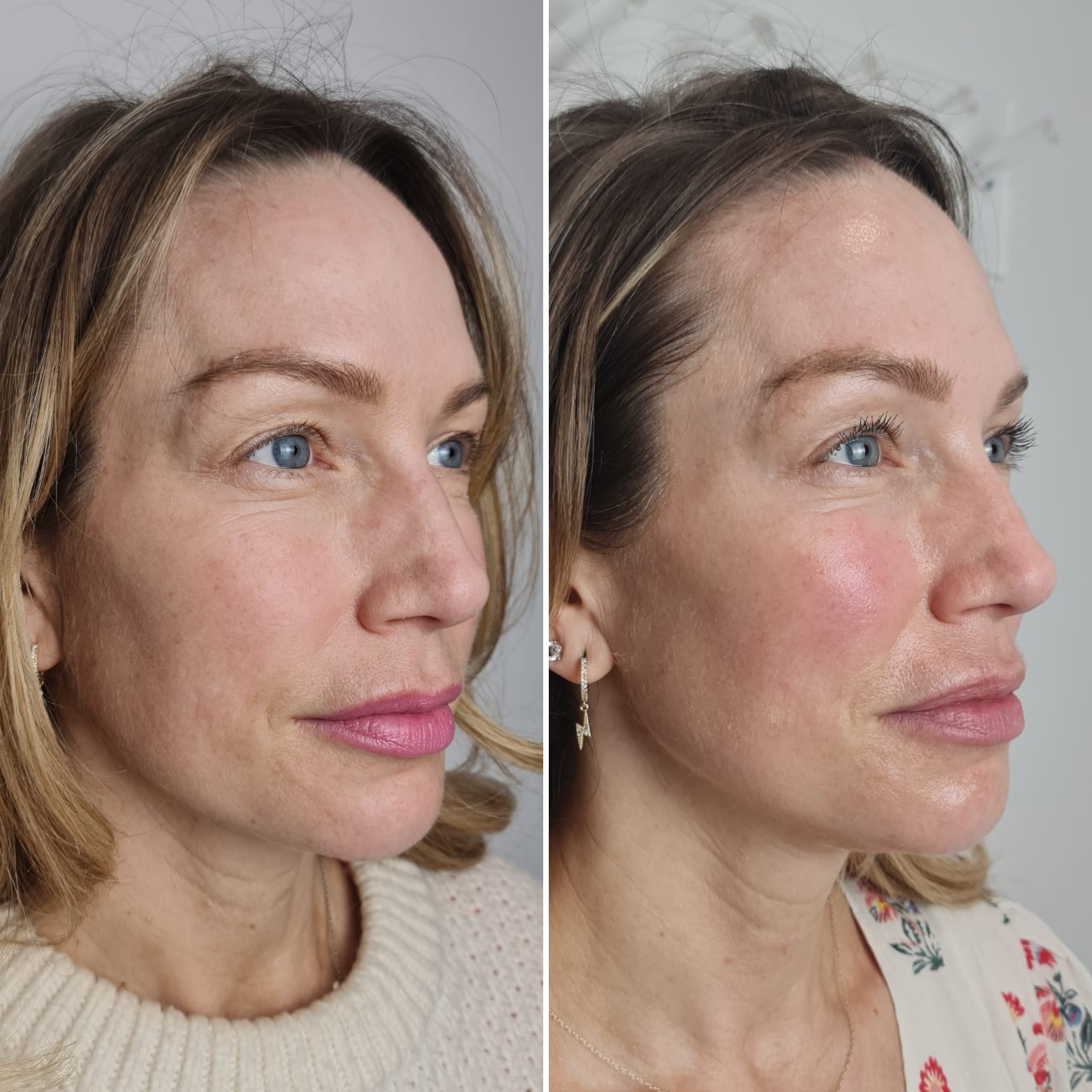 HydraFacial | A before and after photo of a client  who had a HydraFacial at Dr Hala Medical Aesthetics