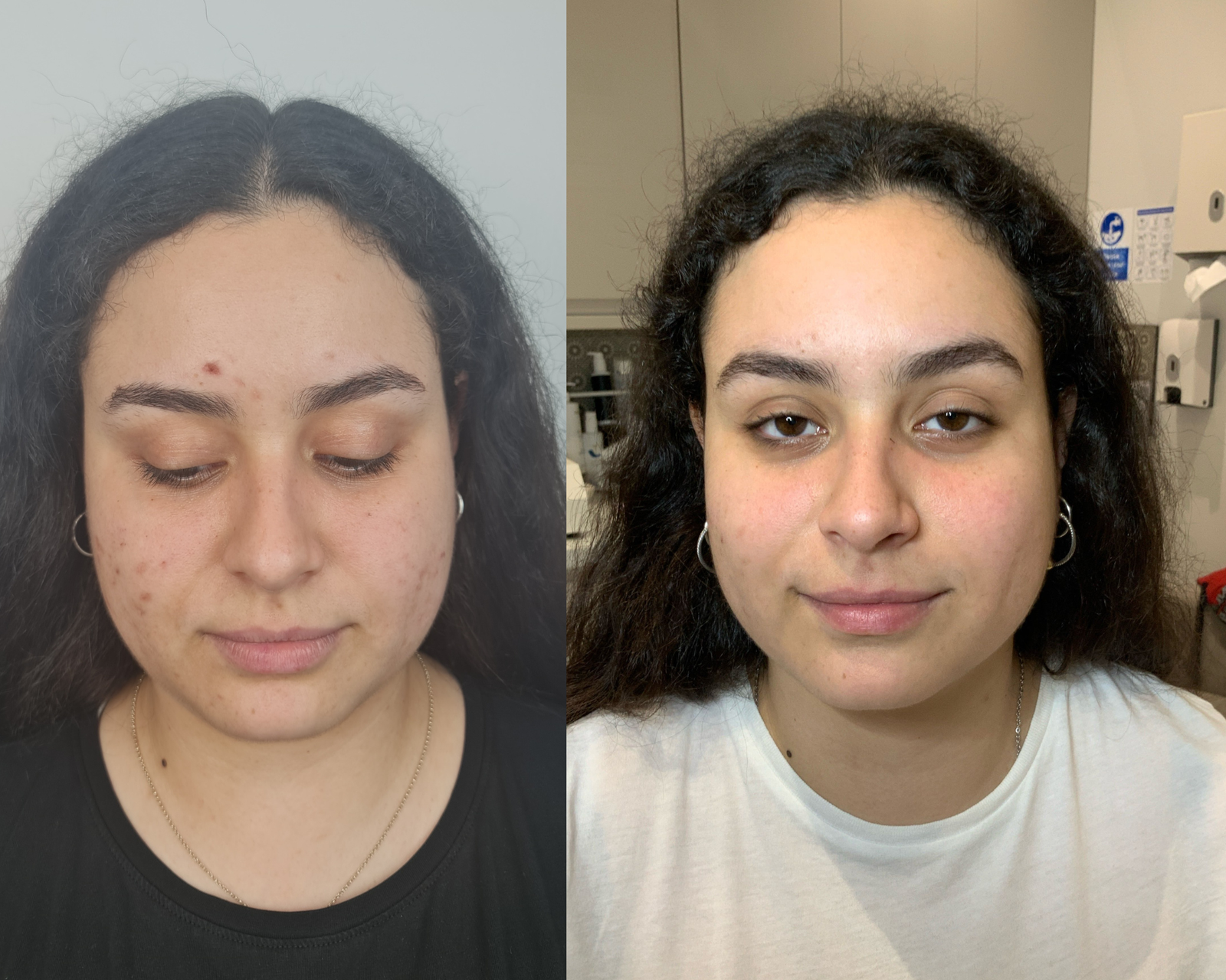 Acne Cure | A before and after of a client treated for acne at Dr Hala Medical Aesthetics