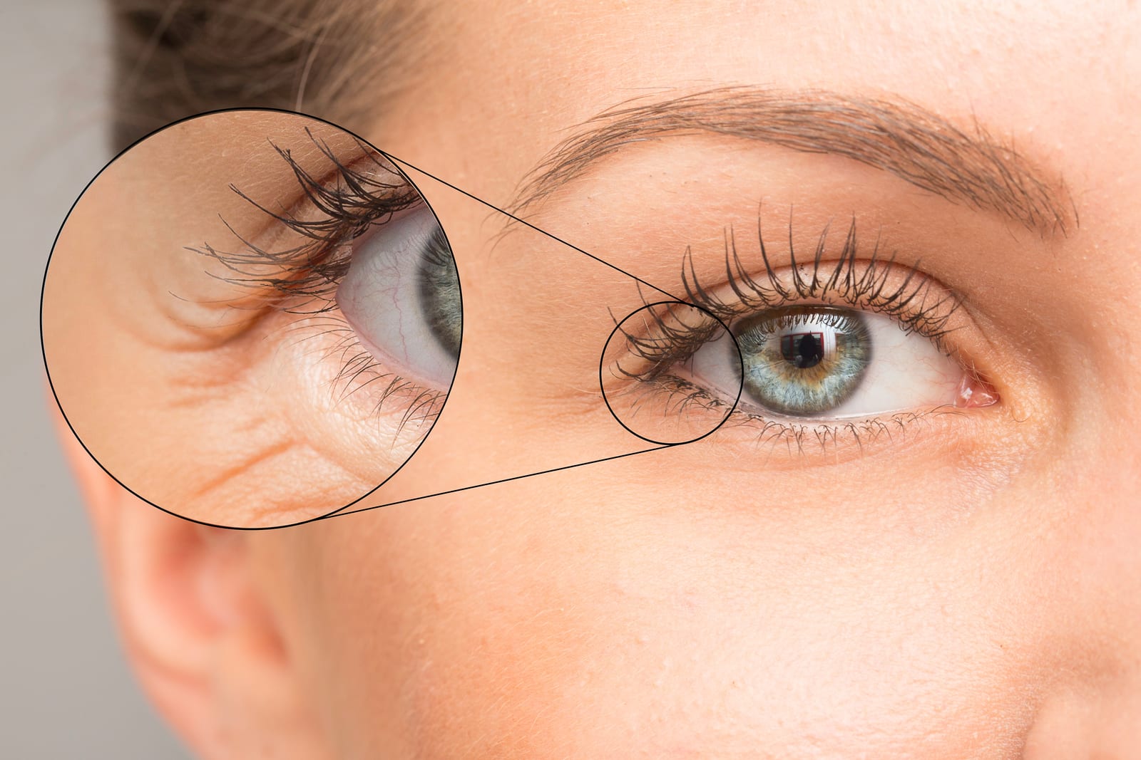 HydraFacial | An example of early signs of aging around the eye